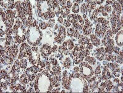 Immunohistochemistry-Paraffin: UQCRC1 Antibody (OTI1G6) [NBP2-03825] - Staining of paraffin-embedded Carcinoma of Human thyroid tissue using anti-UQCRC1 mouse monoclonal antibody.