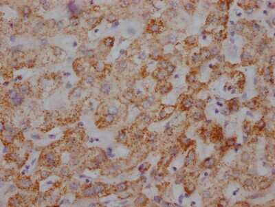 Immunohistochemistry: UQCRC2 Antibody (2F6) [NBP3-15182] - IHC image of UQCRC2 antibody diluted at 1:100 and staining in paraffin-embedded human liver tissue. After dewaxing and hydration, antigen retrieval was mediated by high pressure in a citrate buffer (pH 6.0). Section was blocked with 10% normal goat serum 30 minutes at RT. Then primary antibody (1% BSA) was incubated at 4C overnight. The primary is detected by a Goat anti-rabbit IgG polymer labeled by HRP and visualized using 0.05% DAB.