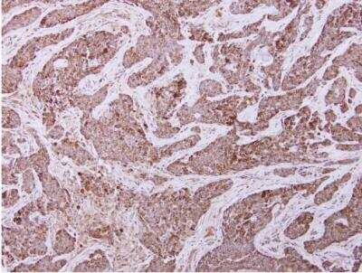 Immunohistochemistry-Paraffin: UQCRC2 Antibody [NBP2-20816] - Paraffin-embedded breast cancer. UQCRC2 antibody dilution: 1:250.