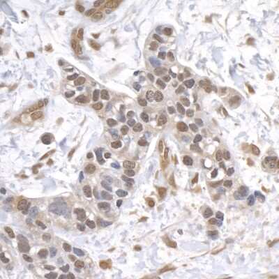 Immunohistochemistry-Paraffin: USP1 Antibody [NB100-88117] - Section of human breast carcinoma. Antibody: Affinity purified rabbit anti- USP1 used at a dilution of 1:1,000 (1ug/ml). Detection: DAB