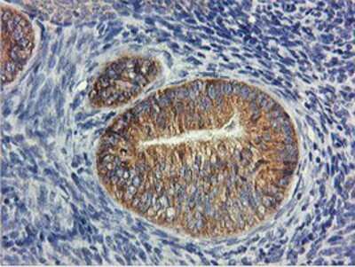 Immunohistochemistry-Paraffin: USP10 Antibody (2E1) [NBP2-01452] - Staining of paraffin-embedded Adenocarcinoma of Human endometrium tissue using anti-USP10 mouse monoclonal antibody.