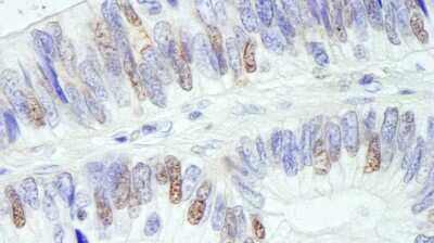 Immunohistochemistry: USP10 Antibody [NB110-40545] - Sample: FFPE section of human colon carcinoma. Antibody: Affinity purified rabbit anti- USP10 used at a dilution of 1:1,000 (0.2ug/ml). Detection: DAB