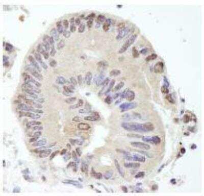 Immunohistochemistry-Paraffin: USP10 Antibody [NB110-40545] - FFPE section of human lung adenocarcinoma.  Affinity purified rabbit anti-USP10 used at a dilution of 1:100.