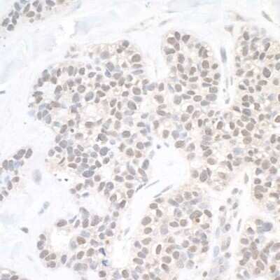 Immunohistochemistry-Paraffin: USP10 Antibody [NB110-40545] - Detection of human USP10 by immunohistochemistry. Sample: FFPE section of human breast carcinoma. Antibody: Affinity purified rabbit anti- USP10 (NB110-40545). Detection: DAB