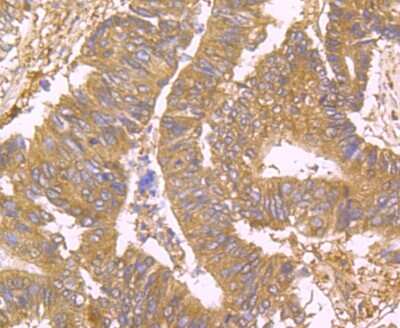 Immunohistochemistry-Paraffin: USP10 Antibody (JU32-62) [NBP2-75698] - Analysis of paraffin-embedded human colon cancer tissue using anti-USP10 antibody. Counter stained with hematoxylin.