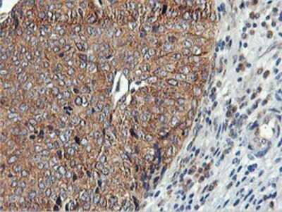 Immunohistochemistry: USP10 Antibody (OTI2E1) - Azide and BSA Free [NBP2-74798] - Staining of paraffin-embedded Carcinoma of Human bladder tissue using anti-USP10 mouse monoclonal antibody.