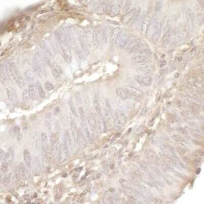 Immunohistochemistry-Paraffin: USP13 Antibody [NBP1-46203] - Section of human colon carcinoma. Antibody: Affinity purified rabbit anti-USP13 (NBP1-46203). Detection: DAB