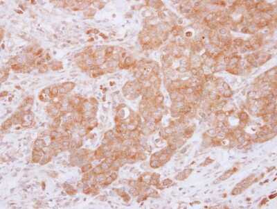 <b>Genetic Strategies Validation. </b>Immunohistochemistry-Paraffin: USP14 Antibody [NBP2-20825] - Immunohistochemical analysis of paraffin-embedded Breast ca, using antibody at 1:500 dilution.