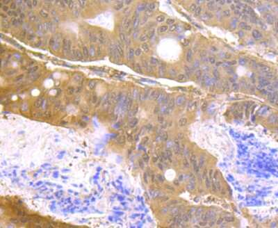 Immunohistochemistry-Paraffin: USP14 Antibody (JU30-49) [NBP2-75700] - Analysis of paraffin-embedded human colon cancer tissue using anti-USP14 antibody. Counter stained with hematoxylin.
