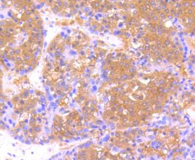 Immunohistochemistry-Paraffin: USP21 Antibody [NBP2-75701] - Analysis of paraffin-embedded human liver cancer tissue using anti-USP21 antibody. Counter stained with hematoxylin.