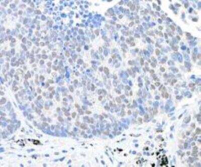 Immunohistochemistry-Paraffin: USP28 Antibody [NB110-40543] -  FFPE section of human lung carcinoma. Antibody: Affinity purified rabbit anti-USP28  used at a dilution of 1:1,000 (0.2ug/ml). Detection: DAB