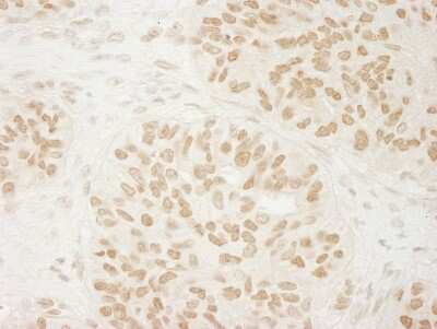 <b>Independent Antibodies Validation and Biological Strategies Validation.</b>Immunohistochemistry: USP33 Antibody [NB110-40693] - Sample: FFPE section of human ovarian carcinoma. Antibody: Affinity purified rabbit anti- USP33 used at a dilution of 1:1,000 (1ug/ml). Detection: DAB