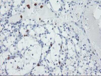 Immunohistochemistry: USP36 Antibody (OTI7G3) - Azide and BSA Free [NBP2-74806] - Staining of paraffin-embedded Carcinoma of Human kidney tissue using anti-USP36 mouse monoclonal antibody.