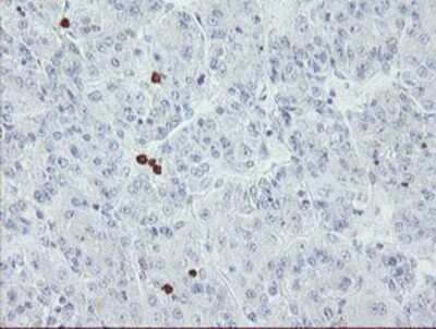 Immunohistochemistry: USP36 Antibody (OTI7G3) - Azide and BSA Free [NBP2-74806] - Staining of paraffin-embedded Carcinoma of Human liver tissue using anti-USP36 mouse monoclonal antibody.