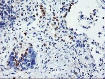Immunohistochemistry: USP36 Antibody (OTI7G3) - Azide and BSA Free [NBP2-74806] - Staining of paraffin-embedded Carcinoma of Human lung tissue using anti-USP36 mouse monoclonal antibody.