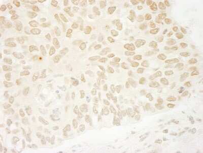 <b>Independent Antibodies Validation and Biological Strategies Validation.</b>Immunohistochemistry: USP37 Antibody [NB110-40709] - Sample: FFPE section of human non-small cell lung cancer. Antibody: Affinity purified rabbit anti- USP37 used at a dilution of 1:200 (1ug/ml). Detection: DAB