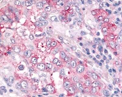 Immunohistochemistry-Paraffin: USP4 Antibody [NB100-90597] - Analysis of anti-USP4 / UNP antibody with human lung, non-small cell carcinoma.