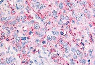 Immunohistochemistry-Paraffin: USP4 Antibody [NB100-90597] - Anti-USP4 antibody IHC of human Lung, Non-Small Cell Carcinoma. Immunohistochemistry of formalin-fixed, paraffin-embedded tissue after heat-induced antigen retrieval.