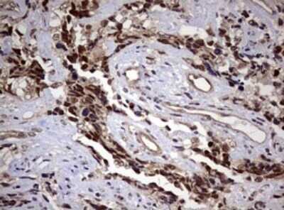Immunohistochemistry: USP44 Antibody (OTI1D1) - Azide and BSA Free [NBP2-74811] - Analysis of Adenocarcinoma of Human endometrium tissue. (Heat-induced epitope retrieval by 10mM citric buffer, pH6.0, 120C for 3min)