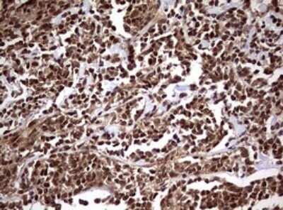 Immunohistochemistry: USP44 Antibody (OTI1D1) - Azide and BSA Free [NBP2-74811] - Analysis of Human lymphoma tissue. (Heat-induced epitope retrieval by 10mM citric buffer, pH6.0, 120C for 3min)