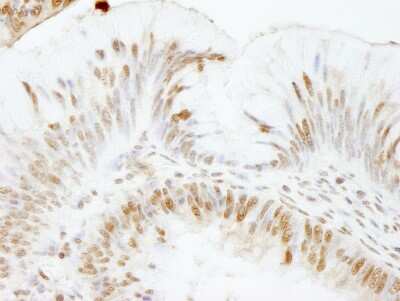 Immunohistochemistry-Paraffin: USP47 Antibody [NB100-57487] - Sample: FFPE section of human colon carcinoma. Antibody: Affinity purified rabbit anti- USP47 used at a dilution of 1:1,000 (1ug/ml). Detection: DAB