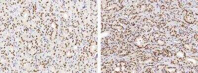 Immunohistochemistry-Paraffin: USP7 Antibody (06) [NBP3-06428] - Immunochemical staining of human USP7 in human prostatic carcinoma (from 2 donors) with mouse monoclonal antibody (1:100, formalin-fixed paraffin embedded sections).