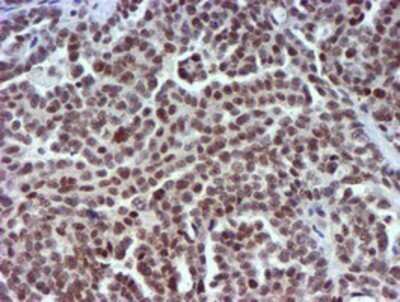 Immunohistochemistry: USP7 Antibody (OTI1F12) - Azide and BSA Free [NBP2-74814] - Staining of paraffin-embedded Adenocarcinoma of Human ovary tissue using anti-USP7 mouse monoclonal antibody.