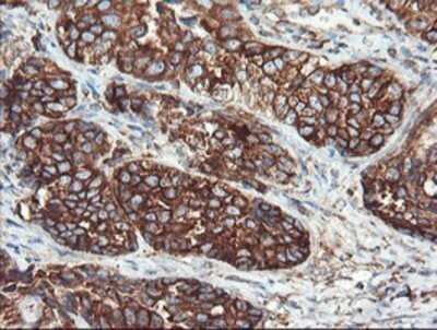 Immunohistochemistry: USP9x Antibody (OTI2G7) - Azide and BSA Free [NBP2-74822] - Staining of paraffin-embedded Adenocarcinoma of Human ovary tissue using anti-USP9x mouse monoclonal antibody.