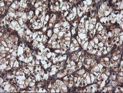 Immunohistochemistry: USP9x Antibody (OTI2G7) - Azide and BSA Free [NBP2-74822] - Staining of paraffin-embedded Carcinoma of Human kidney tissue using anti-USP9x mouse monoclonal antibody.