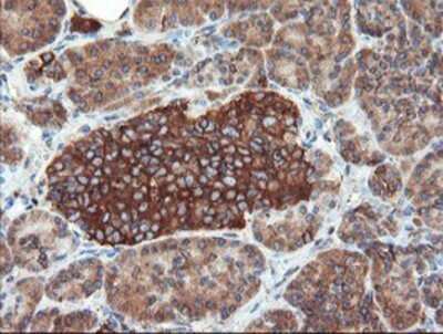 Immunohistochemistry: USP9x Antibody (OTI2G7) - Azide and BSA Free [NBP2-74822] - Staining of paraffin-embedded Carcinoma of Human pancreas tissue using anti-USP9x mouse monoclonal antibody.