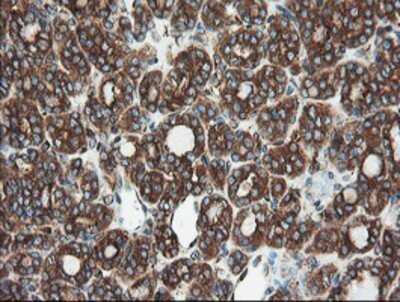 Immunohistochemistry: USP9x Antibody (OTI2G7) - Azide and BSA Free [NBP2-74822] - Staining of paraffin-embedded Carcinoma of Human thyroid tissue using anti-USP9x mouse monoclonal antibody.