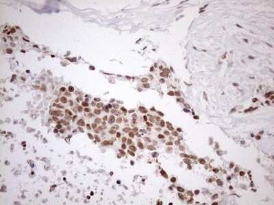 Immunohistochemistry: UTP11L Antibody (5F3) [NBP2-46318] - Analysis of Adenocarcinoma of Human endometrium tissue. (Heat-induced epitope retrieval by 1mM EDTA in 10mM Tris buffer (pH8.5) at 120C for 3 min)