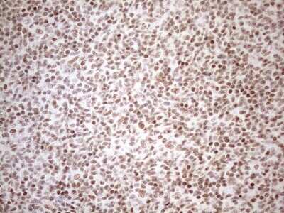 Immunohistochemistry: UTP11L Antibody (5F3) [NBP2-46318] - Analysis of Human lymphoma tissue. (Heat-induced epitope retrieval by 1mM EDTA in 10mM Tris buffer (pH8.5) at 120C for 3 min)