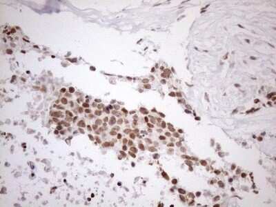 Immunohistochemistry: UTP11L Antibody (OTI5F3) - Azide and BSA Free [NBP2-74823] - Analysis of Adenocarcinoma of Human endometrium tissue. (Heat-induced epitope retrieval by 1mM EDTA in 10mM Tris buffer (pH8.5) at 120C for 3 min)