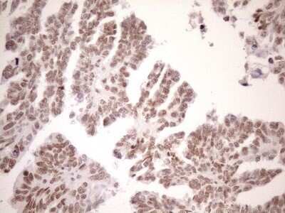Immunohistochemistry: UTP11L Antibody (OTI5F3) - Azide and BSA Free [NBP2-74823] - Analysis of Adenocarcinoma of Human ovary tissue. (Heat-induced epitope retrieval by 1mM EDTA in 10mM Tris buffer (pH8.5) at 120C for 3 min)