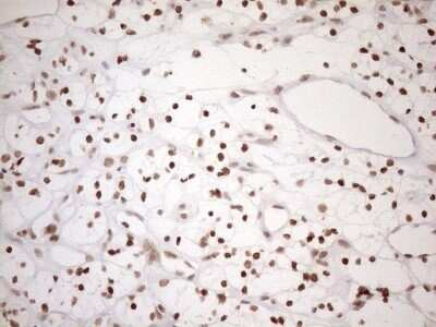 Immunohistochemistry: UTP11L Antibody (OTI5F3) - Azide and BSA Free [NBP2-74823] - Analysis of Carcinoma of Human kidney tissue. (Heat-induced epitope retrieval by 1mM EDTA in 10mM Tris buffer (pH8.5) at 120C for 3 min)
