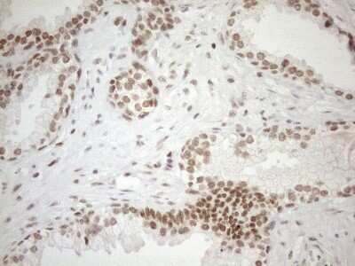 Immunohistochemistry: UTP11L Antibody (OTI5F3) - Azide and BSA Free [NBP2-74823] - Analysis of Carcinoma of Human prostate tissue. (Heat-induced epitope retrieval by 1mM EDTA in 10mM Tris buffer (pH8.5) at 120C for 3 min)
