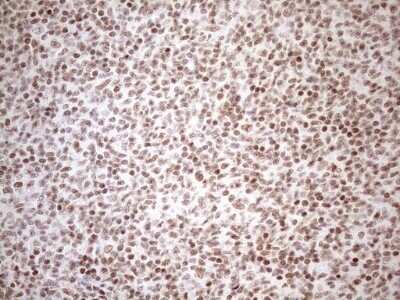 Immunohistochemistry: UTP11L Antibody (OTI5F3) - Azide and BSA Free [NBP2-74823] - Analysis of Human lymphoma tissue. (Heat-induced epitope retrieval by 1mM EDTA in 10mM Tris buffer (pH8.5) at 120C for 3 min)