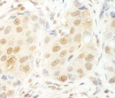 Immunohistochemistry-Paraffin: UTP6 Antibody [NBP1-30467] - Human breast carcinoma. Antibody used at a dilution of 1:1,000.