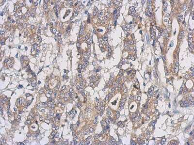 Immunohistochemistry-Paraffin: UXS1 Antibody [NBP2-20841] -  Human gastric cancer, using UXS1 antibody at 1:500 dilution. Antigen Retrieval: Trilogy™ (EDTA based, pH 8.0) buffer, 15min.
