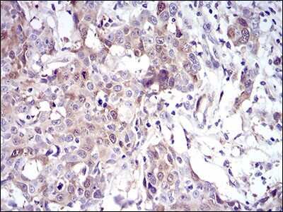 Immunohistochemistry-Paraffin: UbcH10/UBE2C Antibody (1F5D3) [NBP2-52580] - Analysis of paraffin-embedded esophageal cancer tissues using UBE2C mouse mAb with DAB staining.