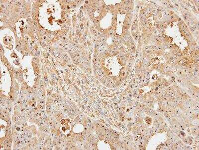 Immunohistochemistry-Paraffin: UbcH5a/UBE2D1 Antibody [NBP1-32734] -  TOV-112D xenograft, using UBE2D1 antibody at 1:500 dilution. Antigen Retrieval: Trilogy™ (EDTA based, pH 8.0) buffer, 15min.