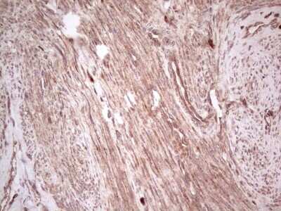 Immunohistochemistry: UbcH5b/UBE2D2 Antibody (2C2) [NBP2-46270] - Analysis of Adenocarcinoma of Human endometrium tissue. (Heat-induced epitope retrieval by 1 mM EDTA in 10mM Tris, pH8.5, 120C for 3min)