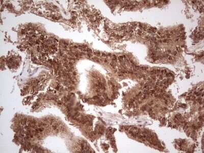 Immunohistochemistry: UbcH5b/UBE2D2 Antibody (2C2) [NBP2-46270] - Analysis of Carcinoma of Human prostate tissue. (Heat-induced epitope retrieval by 1 mM EDTA in 10mM Tris, pH8.5, 120C for 3min)