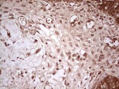 Immunohistochemistry: UbcH5b/UBE2D2 Antibody (2C2) [NBP2-46270] - Analysis of Carcinoma of Human bladder tissue. (Heat-induced epitope retrieval by 1 mM EDTA in 10mM Tris, pH8.5, 120C for 3min)