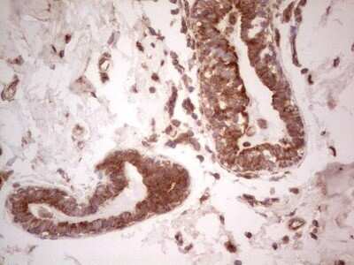 Immunohistochemistry: UbcH5b/UBE2D2 Antibody (OTI2C2) - Azide and BSA Free [NBP2-74732] - Analysis of Adenocarcinoma of Human breast tissue. (Heat-induced epitope retrieval by 1 mM EDTA in 10mM Tris, pH8.5, 120C for 3min)