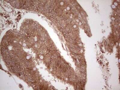 Immunohistochemistry: UbcH5b/UBE2D2 Antibody (OTI2C2) - Azide and BSA Free [NBP2-74732] - Analysis of Adenocarcinoma of Human colon tissue. (Heat-induced epitope retrieval by 1 mM EDTA in 10mM Tris, pH8.5, 120C for 3min)