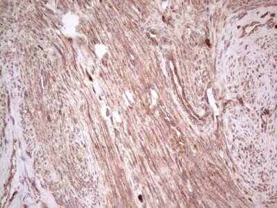 Immunohistochemistry: UbcH5b/UBE2D2 Antibody (OTI2C2) - Azide and BSA Free [NBP2-74732] - Analysis of Adenocarcinoma of Human endometrium tissue. (Heat-induced epitope retrieval by 1 mM EDTA in 10mM Tris, pH8.5, 120C for 3min)