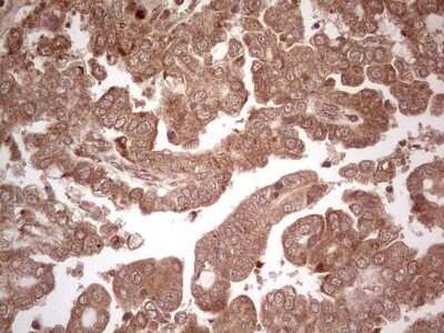 Immunohistochemistry: UbcH5b/UBE2D2 Antibody (OTI2C2) - Azide and BSA Free [NBP2-74732] - Analysis of Adenocarcinoma of Human ovary tissue. (Heat-induced epitope retrieval by 1 mM EDTA in 10mM Tris, pH8.5, 120C for 3min)