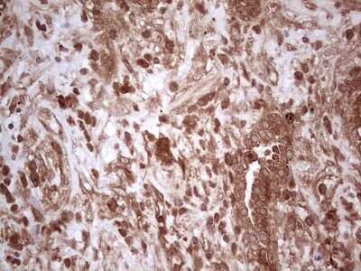 Immunohistochemistry: UbcH5b/UBE2D2 Antibody (OTI2C2) - Azide and BSA Free [NBP2-74732] - Analysis of Carcinoma of Human lung tissue. (Heat-induced epitope retrieval by 1 mM EDTA in 10mM Tris, pH8.5, 120C for 3min)